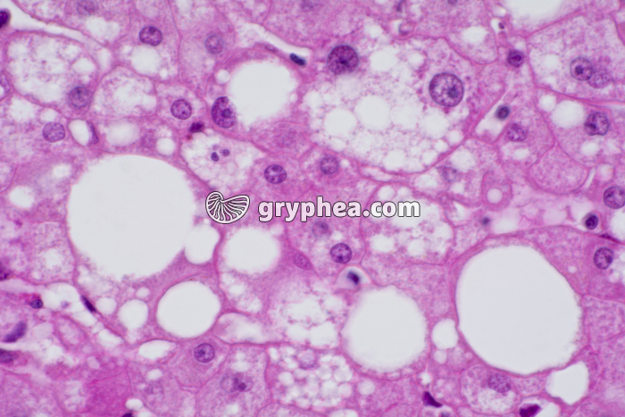 Foie pathologique (Cirrhose) x200 - gryphea.org